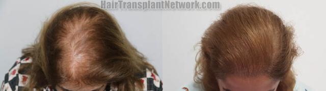 Female hair transplantation surgery before and after images