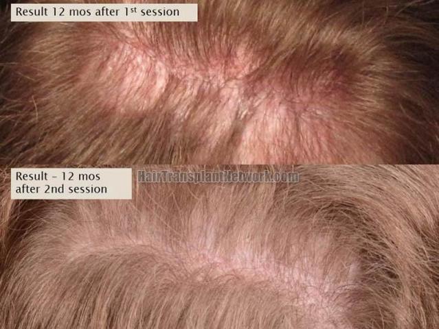 Hair transplantation surgery before and after images