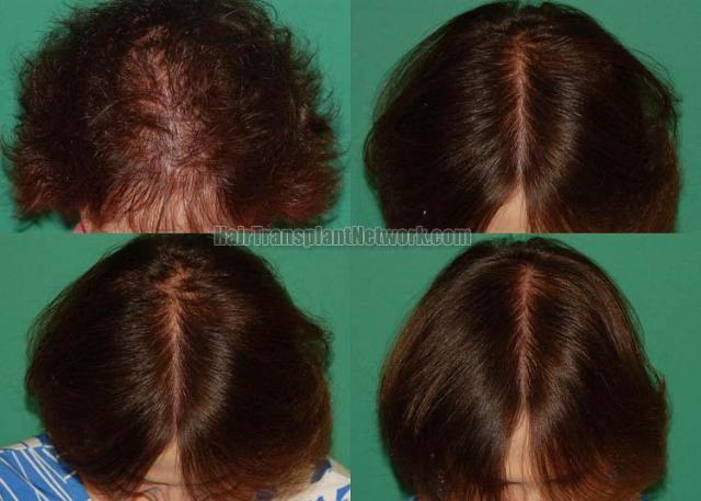 Hair restoration procedure before and after results