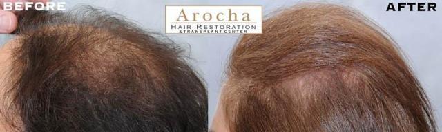 Female hair transplantation surgery before and after images