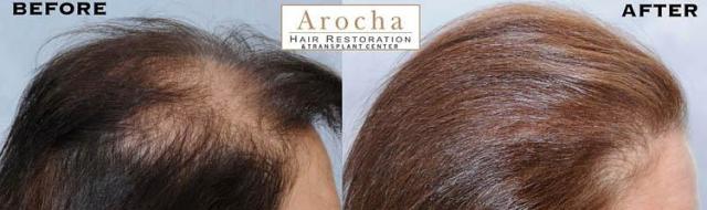 Female hair transplantation surgery before and after images