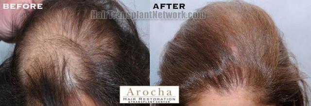 Hair restoration procedure results