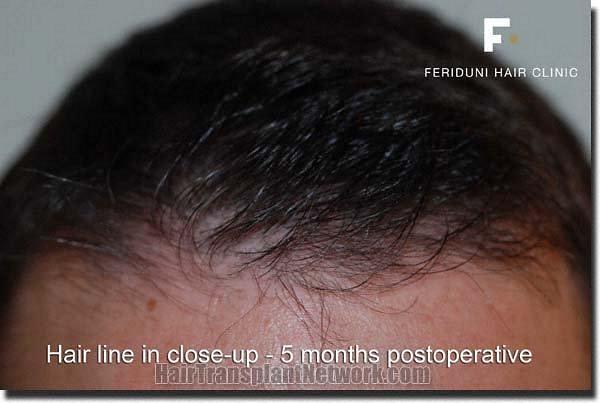 Hair restoration procedure results