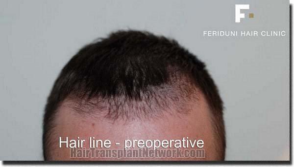 Hair restoration procedure results