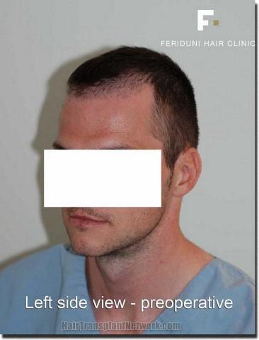 Hair restoration procedure results