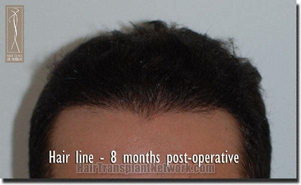 Hair restoration procedure results