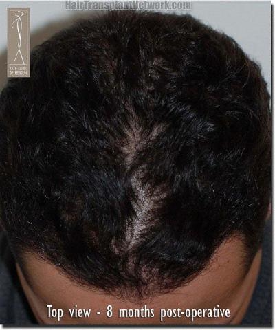 Hair restoration procedure results