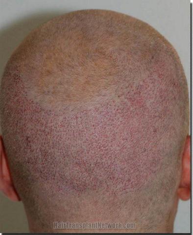 Hair restoration procedure results