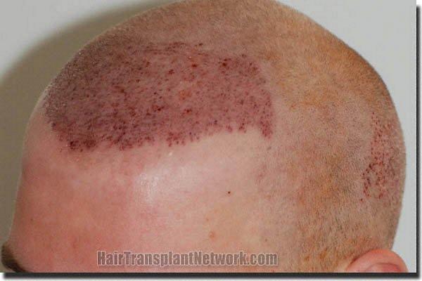 Hair restoration procedure results