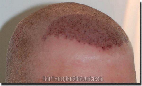 Hair restoration procedure results