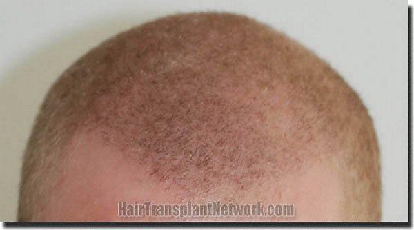 Hair restoration procedure results