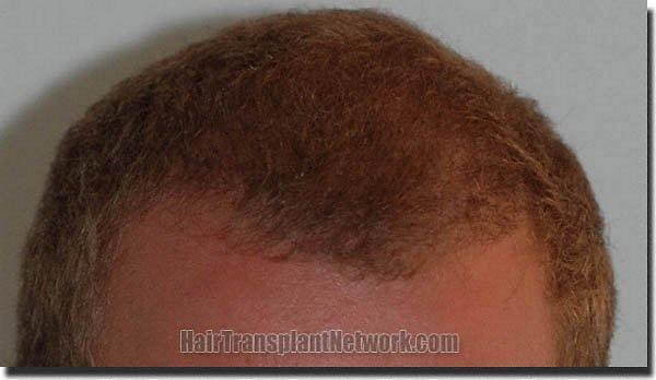 Hair restoration procedure results