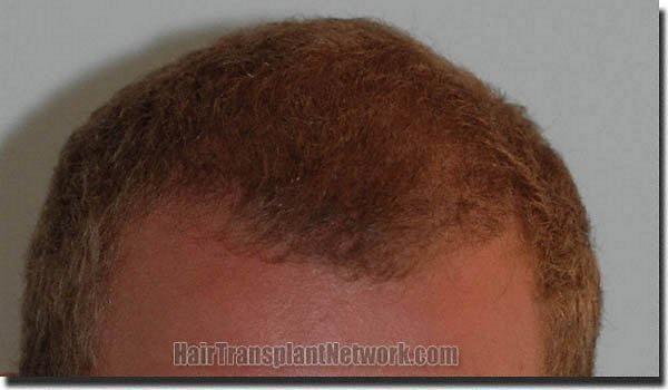 Hair restoration procedure results