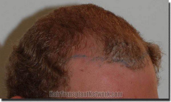 Hair restoration procedure results