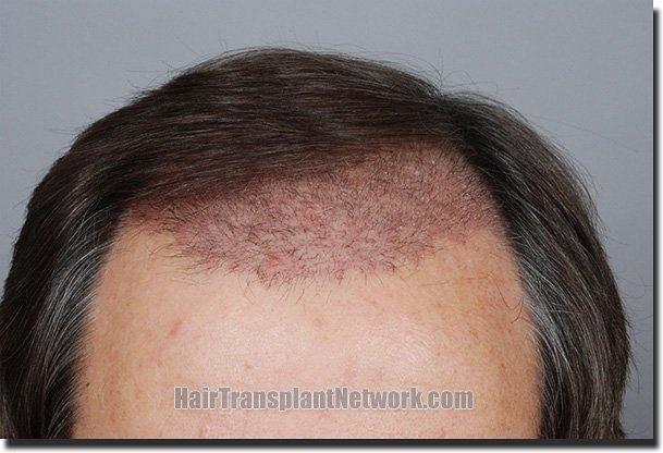 Hair restoration procedure results