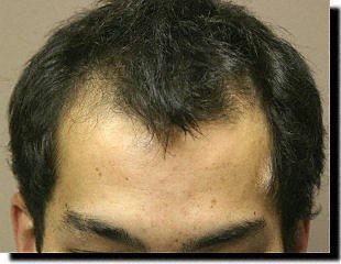 Hair restoration procedure results