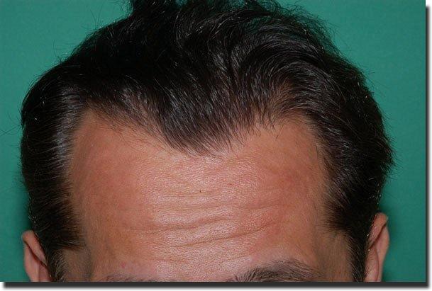 Hair restoration procedure results