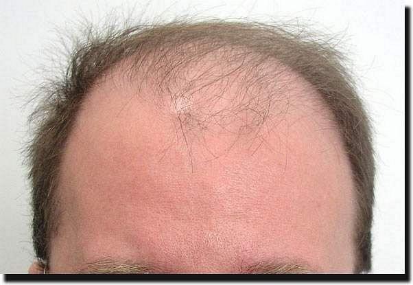 Hair restoration procedure results