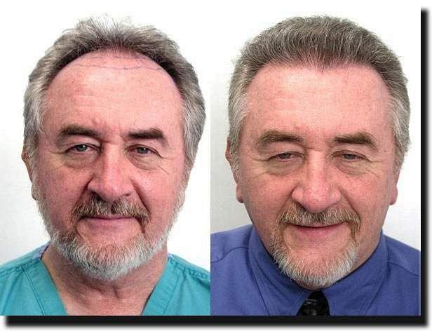 Hair restoration procedure results