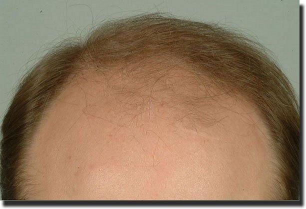 Hair restoration procedure results