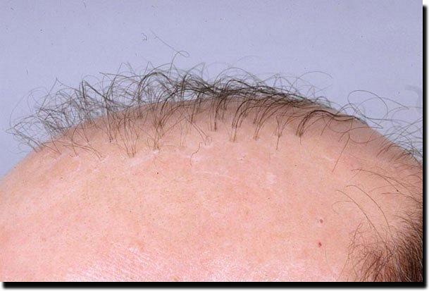 Hair restoration procedure results