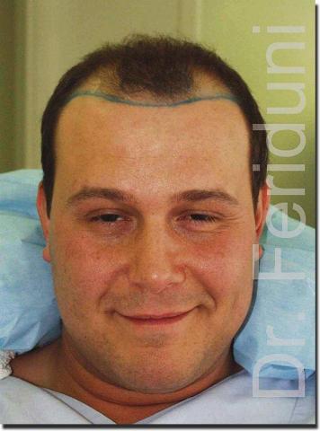 Hair restoration procedure results