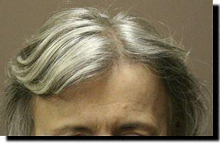 Hair restoration procedure results