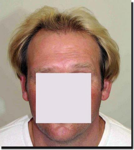 Hair restoration procedure results