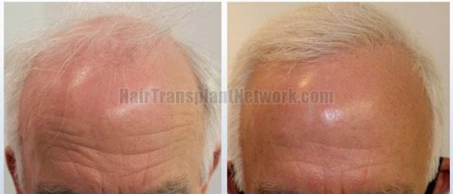 Frontal area before and after surgery 