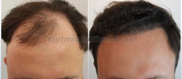 Frontal area before and after surgery 