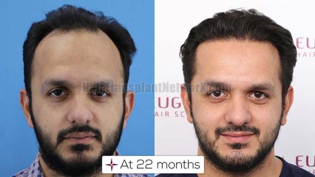 Frontal area before and after surgery 