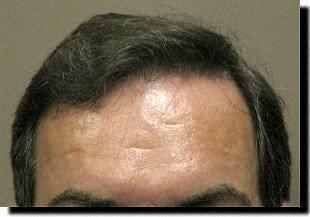 Hair restoration procedure results