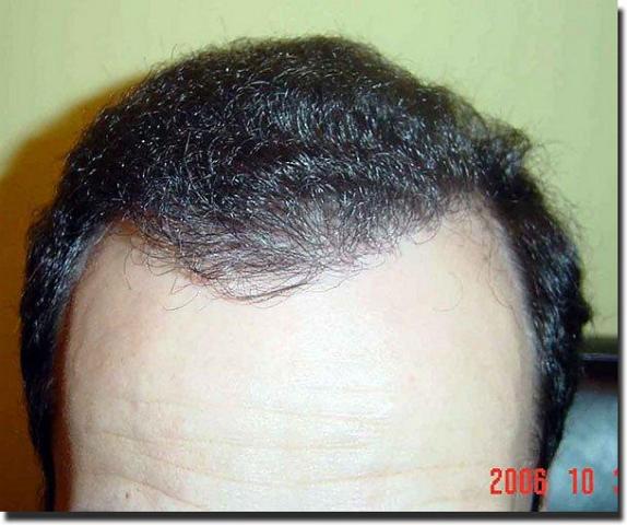 Hair restoration procedure results