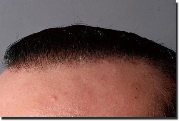 Hair restoration procedure results