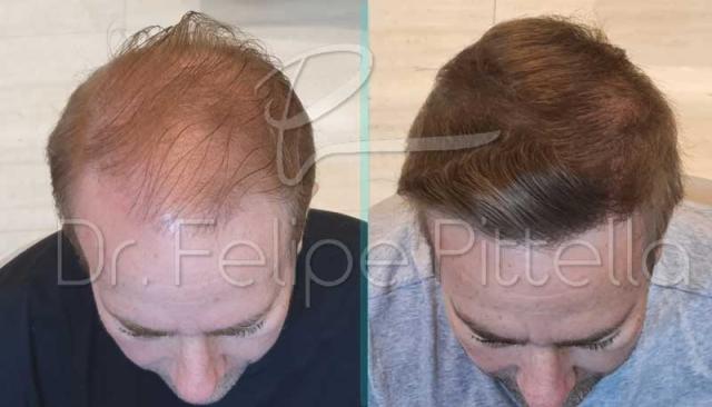 Frontal area before and after hair transplant surgery