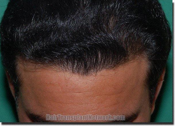 Hair restoration procedure results