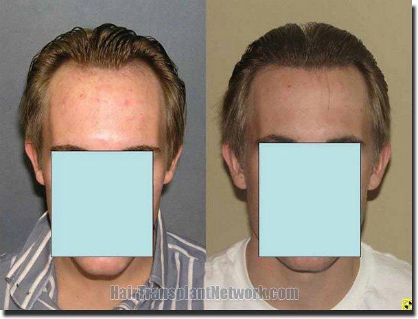 Hair restoration procedure results