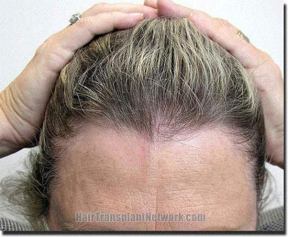 Hair restoration procedure results