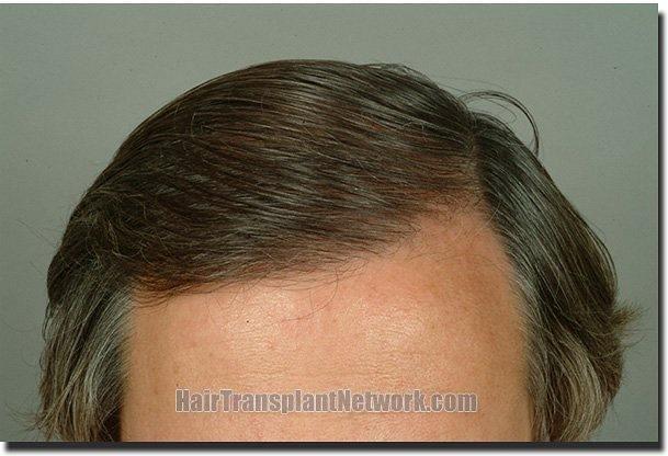 Hair restoration procedure results