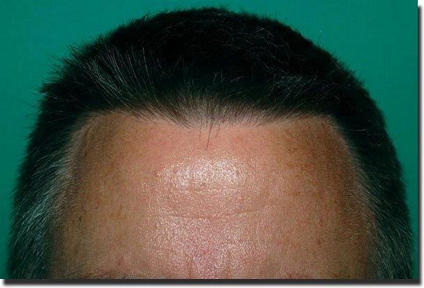 Hair restoration procedure results