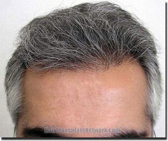 Hair restoration procedure results