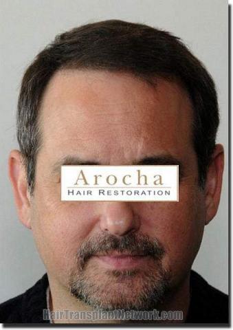 Hair restoration procedure results