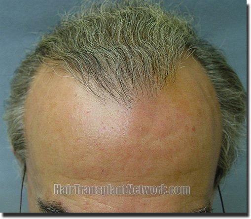 Hair restoration procedure results