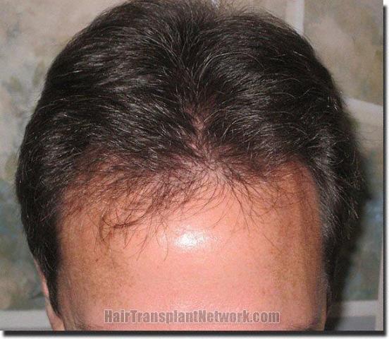 Hair restoration procedure results