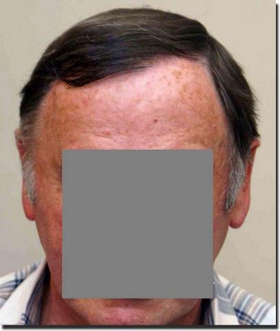 Hair restoration procedure results