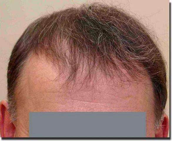 Hair restoration procedure results