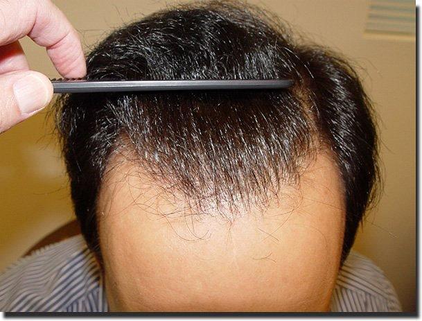 Hair restoration procedure results