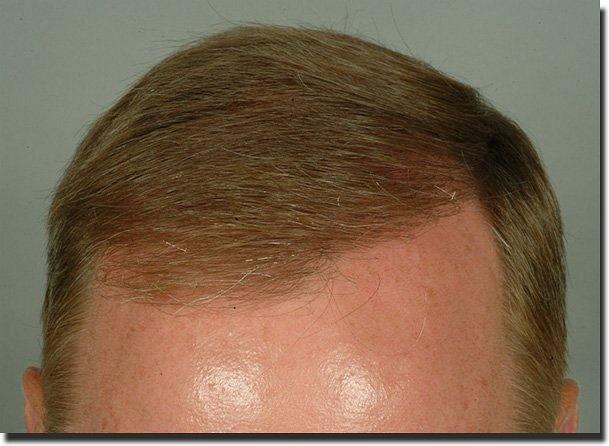 Hair restoration procedure results