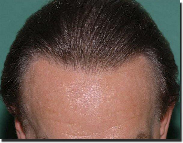 Hair restoration procedure results