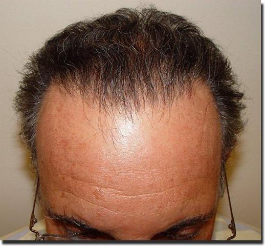 Hair restoration procedure results